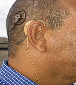 Deafness blog image. Coclear implant. Photograph of a cochlear implant placed over the ear of a person connected with the magnet on the head.